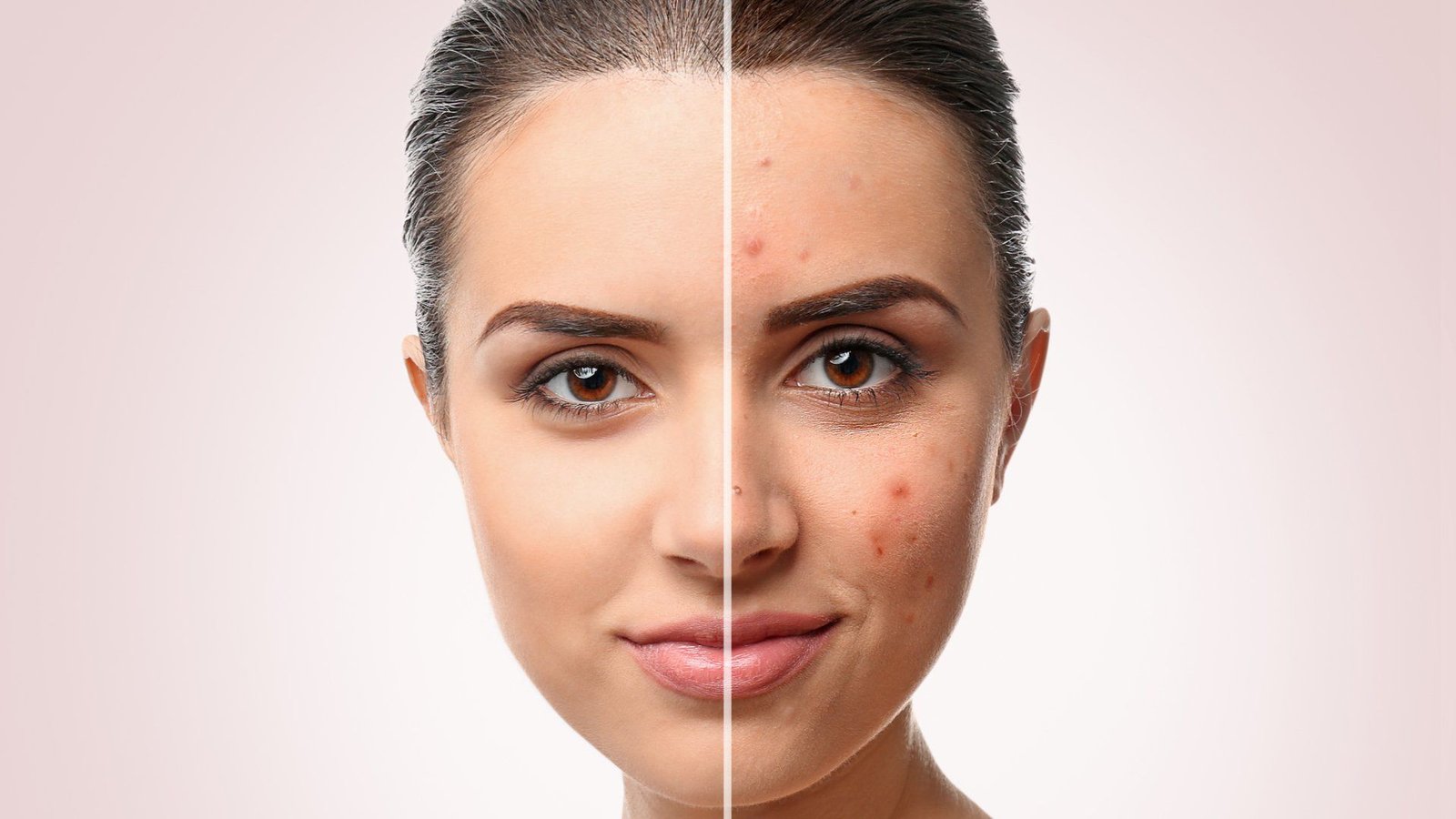 How to Banish Pimples: Effective Strategies for Clearer Skin