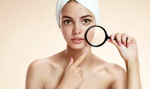How to Understand Acne: Causes and Treatments