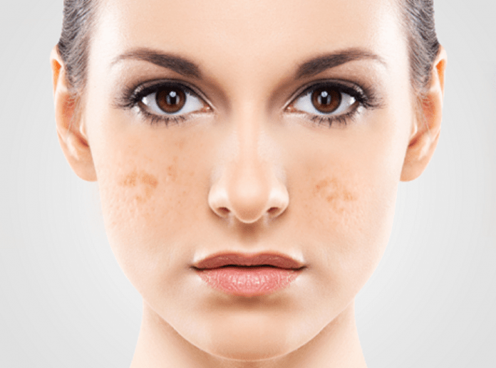 dark spots removal tips